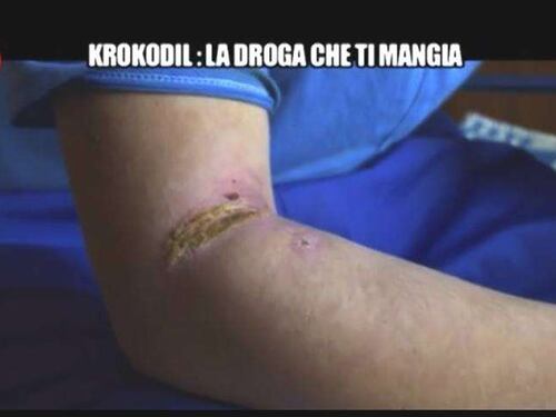 Allerta in Italia per la Krokodil: la droga che scioglie ossa e pelle