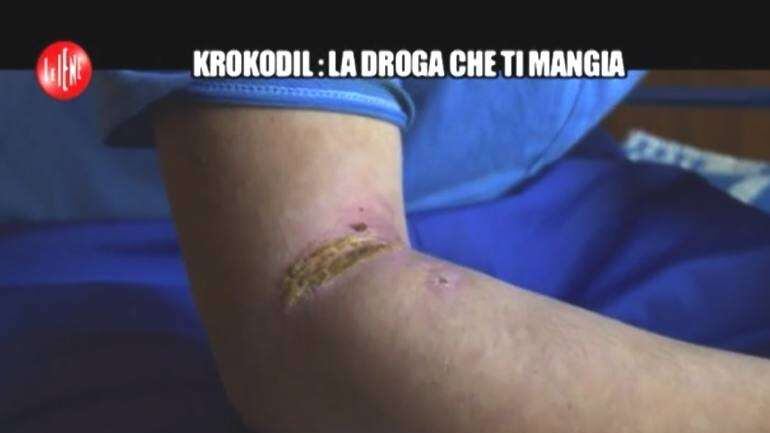 Allerta in Italia per la Krokodil: la droga che scioglie ossa e pelle