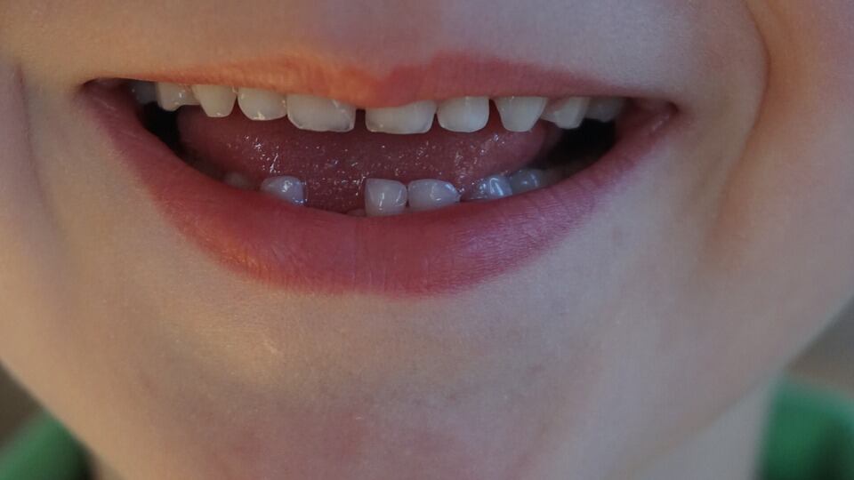 Denti da latte, tutto quello che i genitori devono sapere