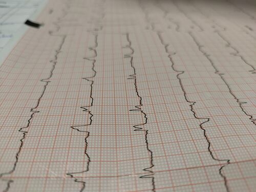 Infarto, qual è la proteina che "ripulisce" le arterie del cuore