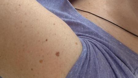 Scoperta una relazione tra i nei presenti sul braccio e il rischio di melanoma