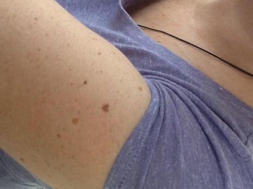 Scoperta una relazione tra i nei presenti sul braccio e il rischio di melanoma