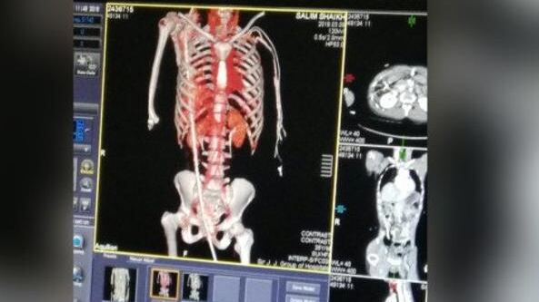Cade da un palazzo e finisce trapassato da barra d’acciaio: è salvo