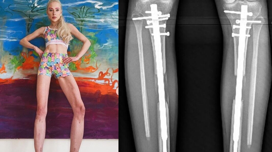 Paga 150mila euro per allungarsi le gambe di 14 centimetri. Ma ora si pente