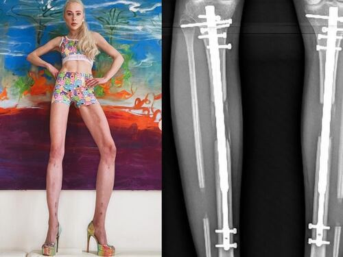 Paga 150mila euro per allungarsi le gambe di 14 centimetri. Ma ora si pente