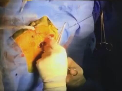 Neonato trapiantato al cuore: genitori pubblicano diretta su facebook