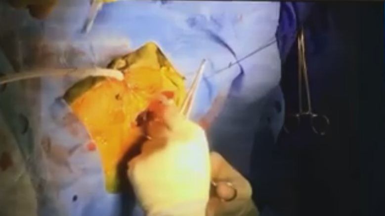 Neonato trapiantato al cuore: genitori pubblicano diretta su facebook
