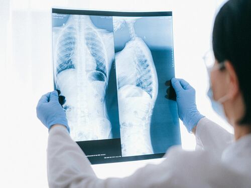 Embolia polmonare: di cosa si tratta, le cause, i sintomi e le 9 tipologie da conoscere