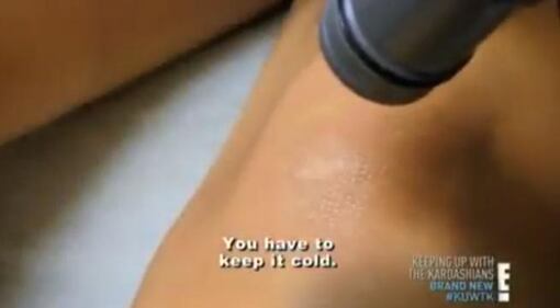 Kim Kardashian, laser sul seno per rimuovere le smagliature 3
