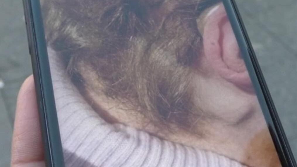 Napoli, 83enne accoltellata durante rapina: la lama ancora nel collo