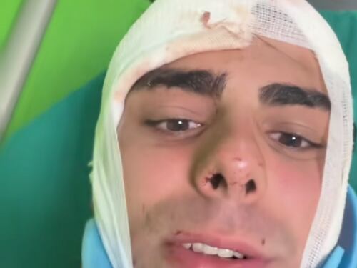 Alessandro, aggredito a Milano per un orologio: "Preso a martellate in testa. Ho rischiato di morire"