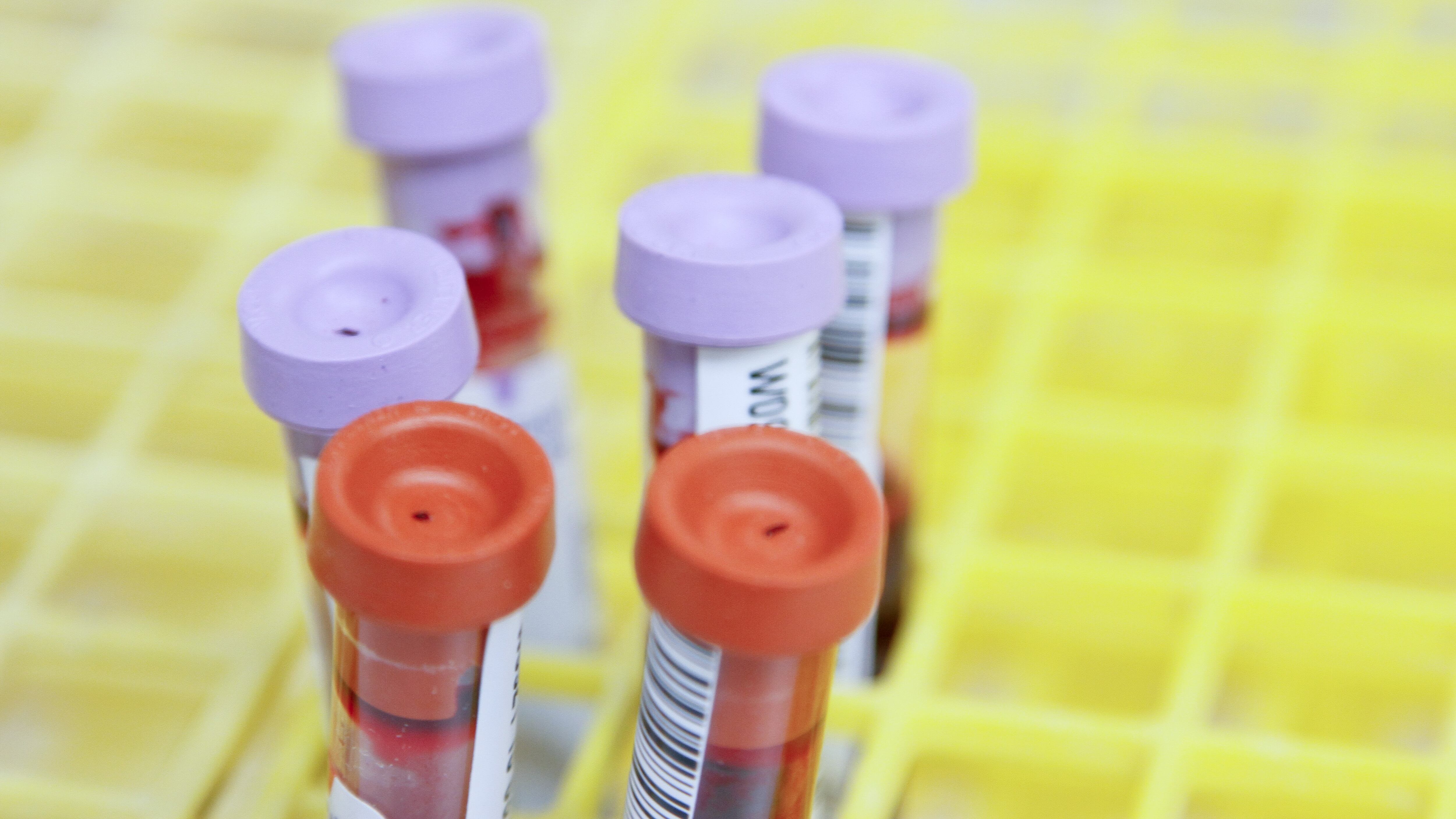 Virus del Congo, caso sospetto a Lucca
