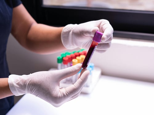 Prevenire il rischio di ictus: i valori da non superare di 3 biomarcatori chiave. Lo studio