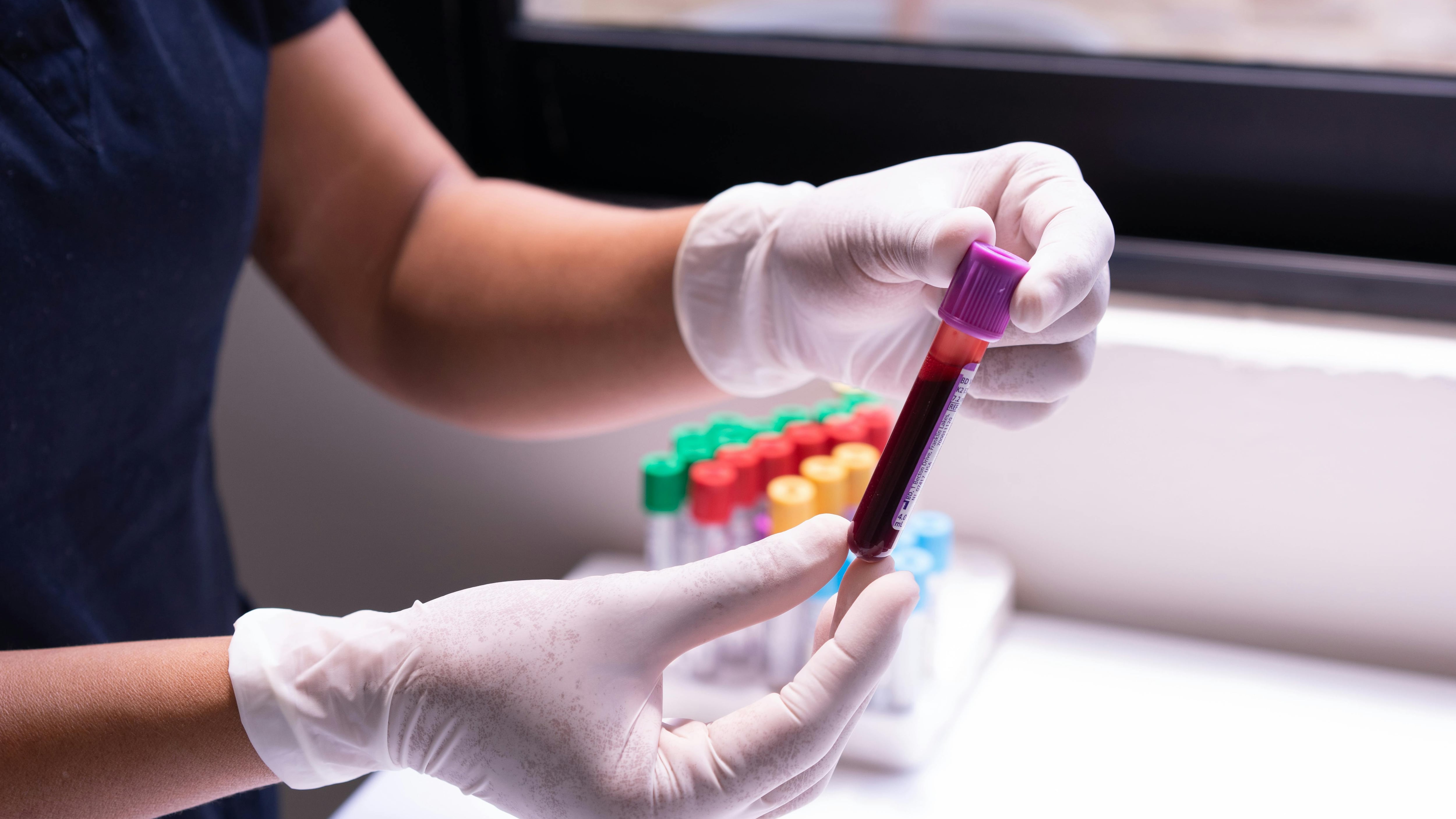 Prevenire il rischio di ictus: i valori da non superare di 3 biomarcatori chiave. Lo studio