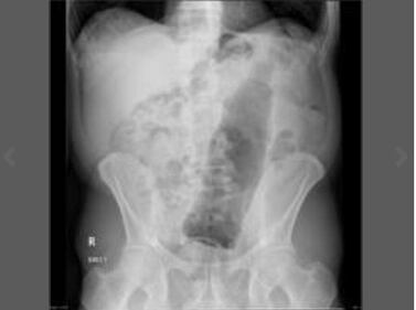 Pazze radiografie: gli oggetti che possono finire nel corpo umano 9