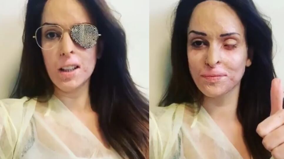 Gessica Notaro toglie la benda dall'occhio sui social: "Devono operarmi di nuovo"