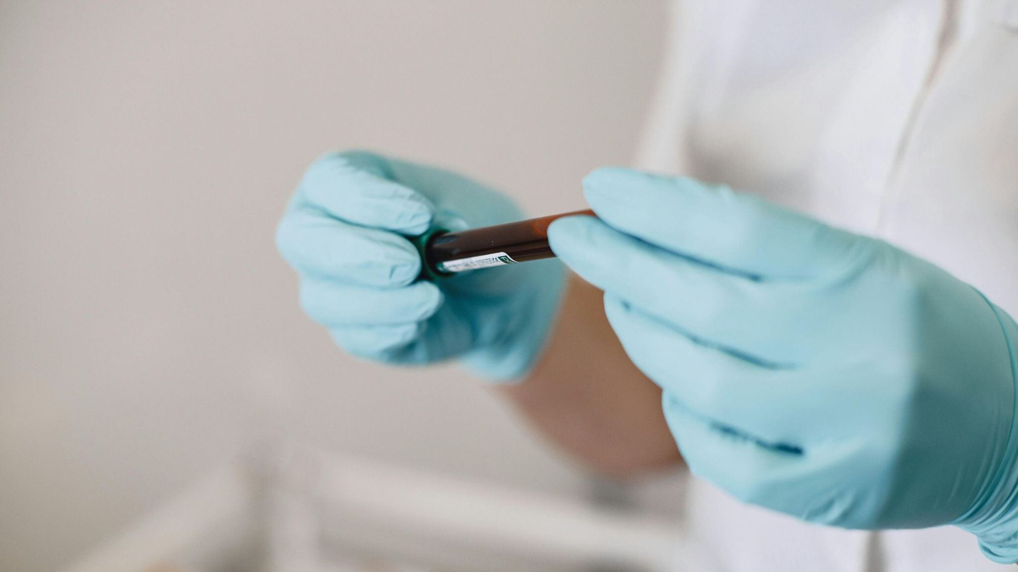 Osteoporosi, i primi sintomi in età adulta: quali sono gli esami del sangue da fare