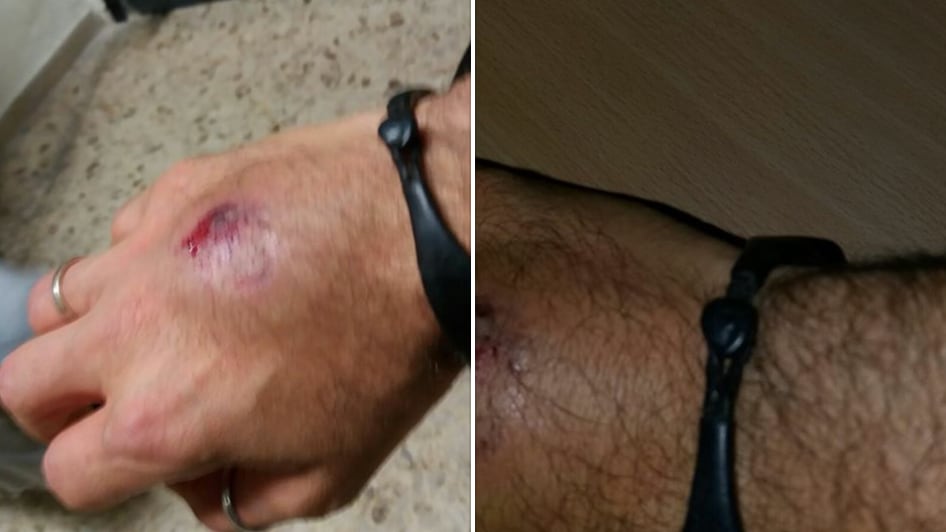 "Immigrato malato ha morso agente. E il giudice lo ha già liberato"