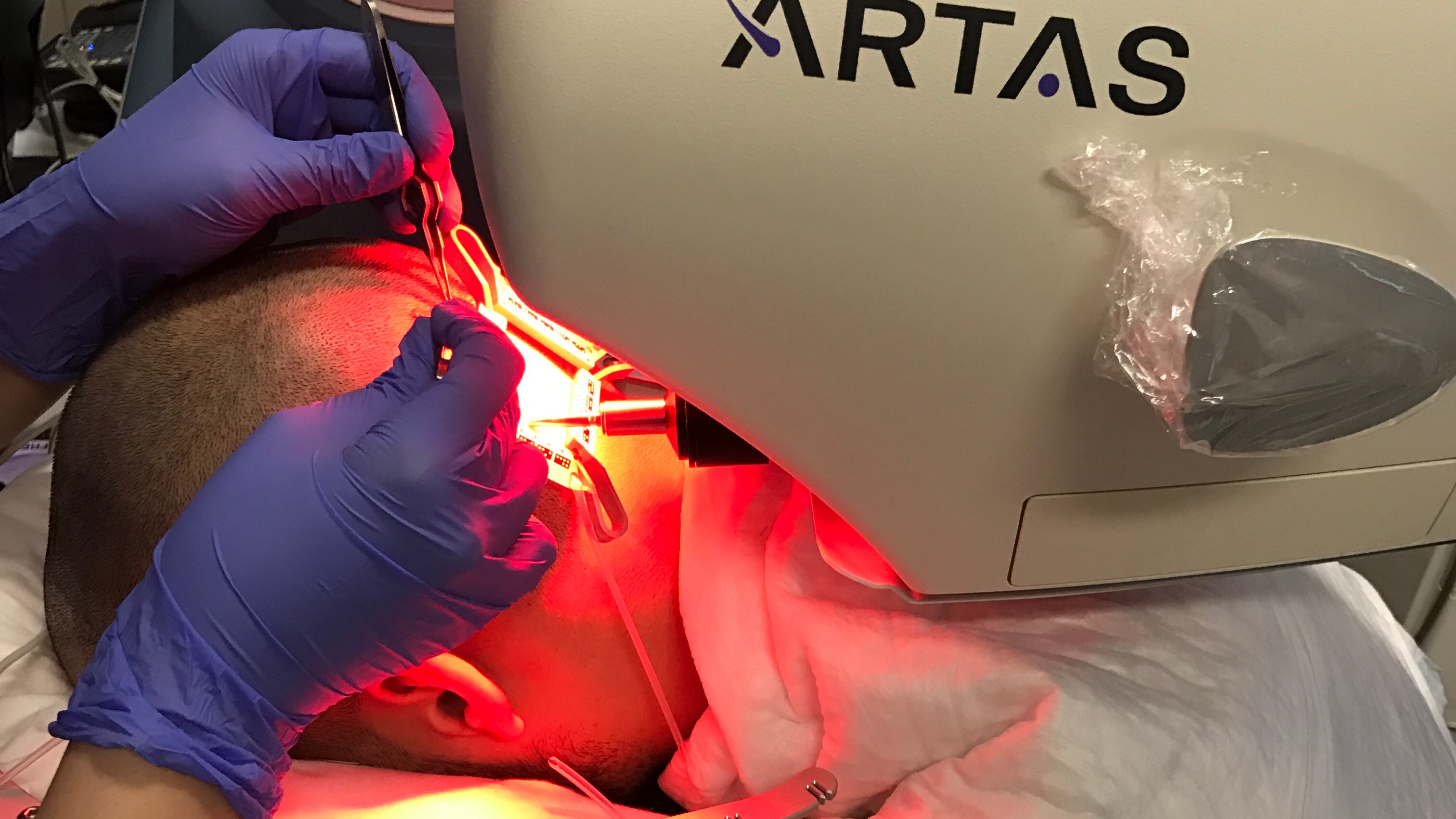 Il trapianto di capelli? Ora si fa con un robot