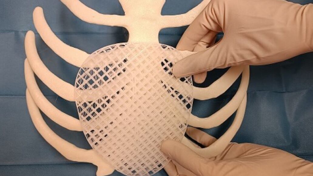 Protesi stampata in 3D riassorbibile, al Meyer il primo intervento in Europa