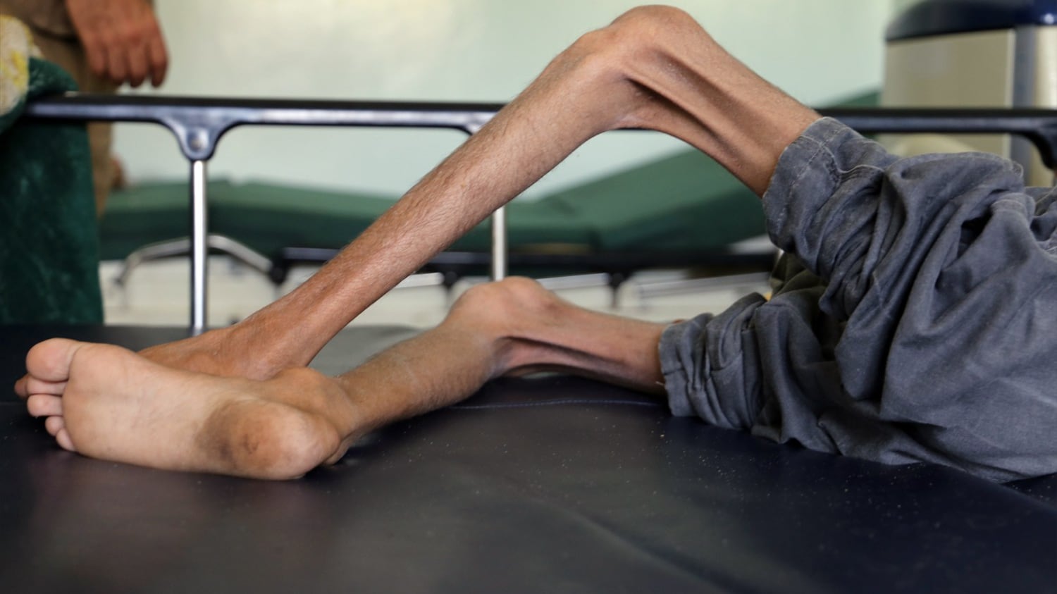 Morta di fame la piccola Amal Simbolo della guerra in Yemen