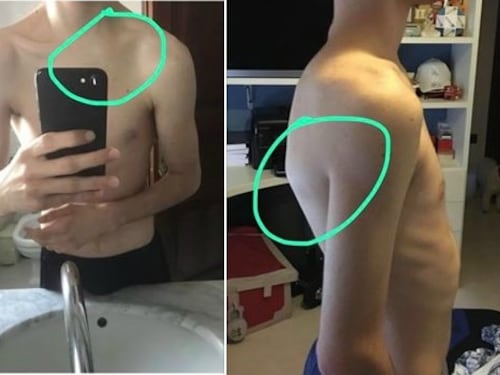 Fine di un incubo, Salvatore finalmente operato alla clavicola