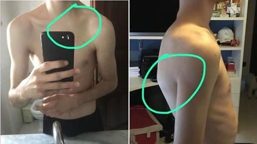 Fine di un incubo, Salvatore finalmente operato alla clavicola