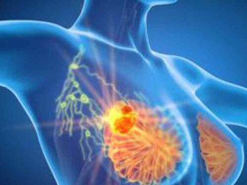 Cancro, ecco come prevenire le metastasi: la nuova scoperta