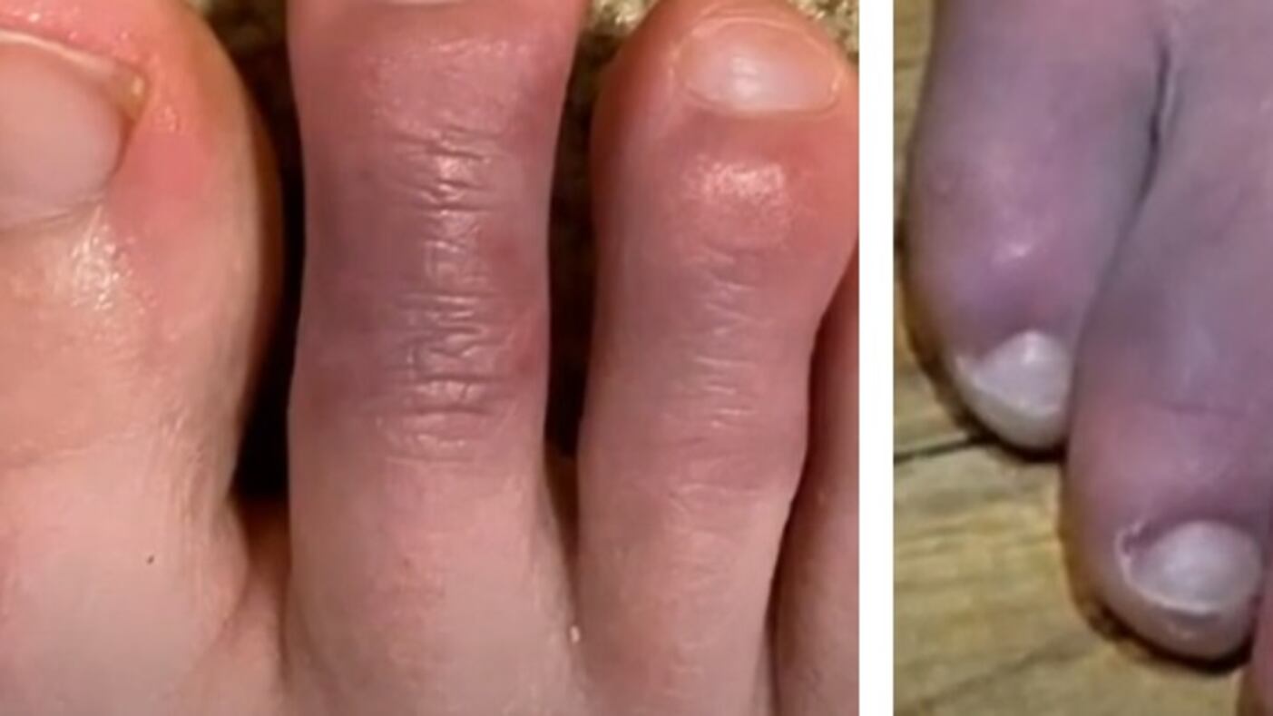 "Quelle lesioni anche per i negativi" Così Covid "mangia" la pelle