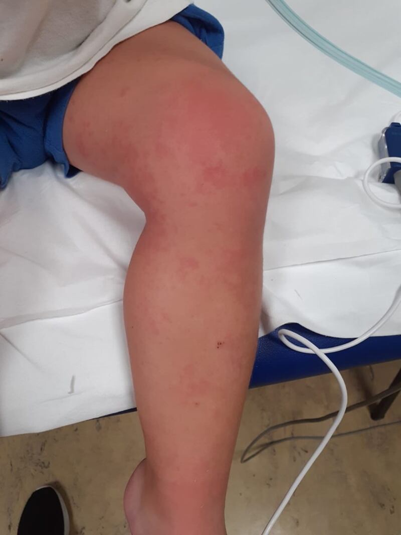 Pescara, bimbo allergico in ospedale dopo aver mangiato budino 2