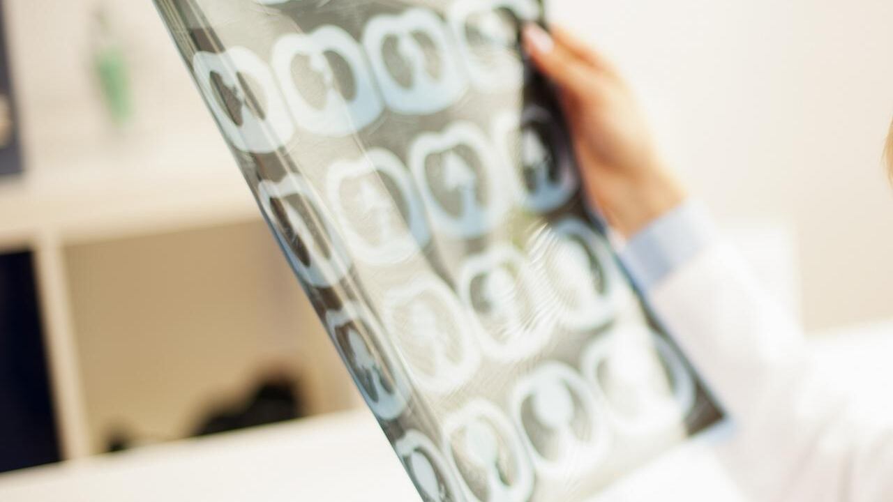 Alzheimer, scoperto nuovo percorso terapeutico: come funziona