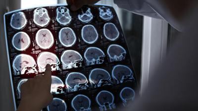 Alzheimer, lo studio italiano che cambia tutto: il ruolo chiave di una proteina