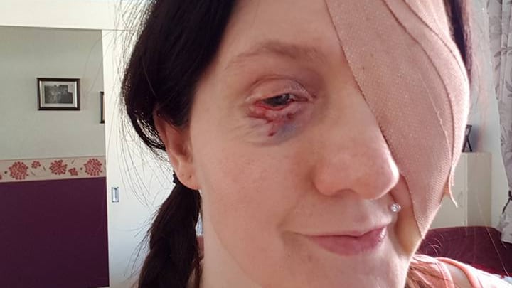 Le esplode un occhio dopo aver fatto la doccia: l'incidente choc