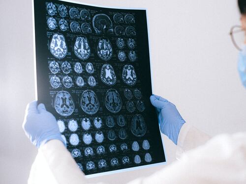 Demenza, scoperto un nuovo trattamento promettente