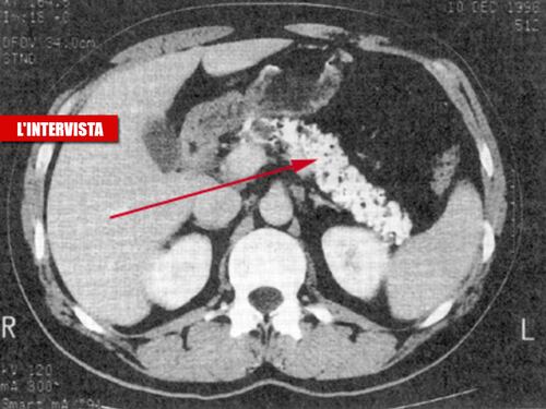 Il Covid "gonfia" il pancreas: "Ecco come scatta l'attacco"