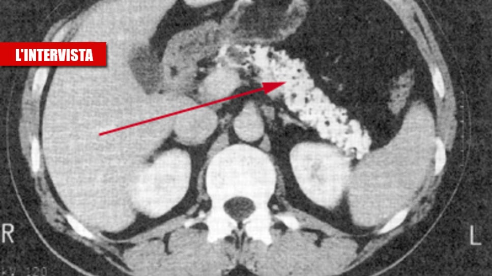 Il Covid "gonfia" il pancreas: "Ecco come scatta l'attacco"