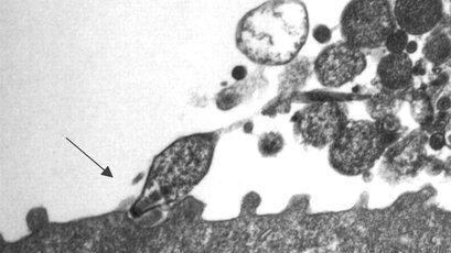 Polmonite atipica, sintomi e segnali diversi: come riconoscerli e perché cambiano le terapie
