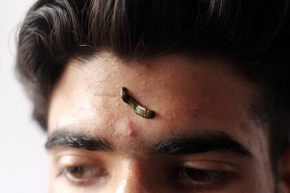 La terapia delle sanguisughe nel Kashmir indiano 14