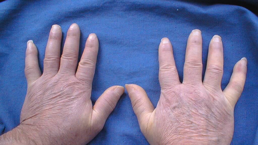 Sclerodermia, di cosa si tratta e come si manifesta
