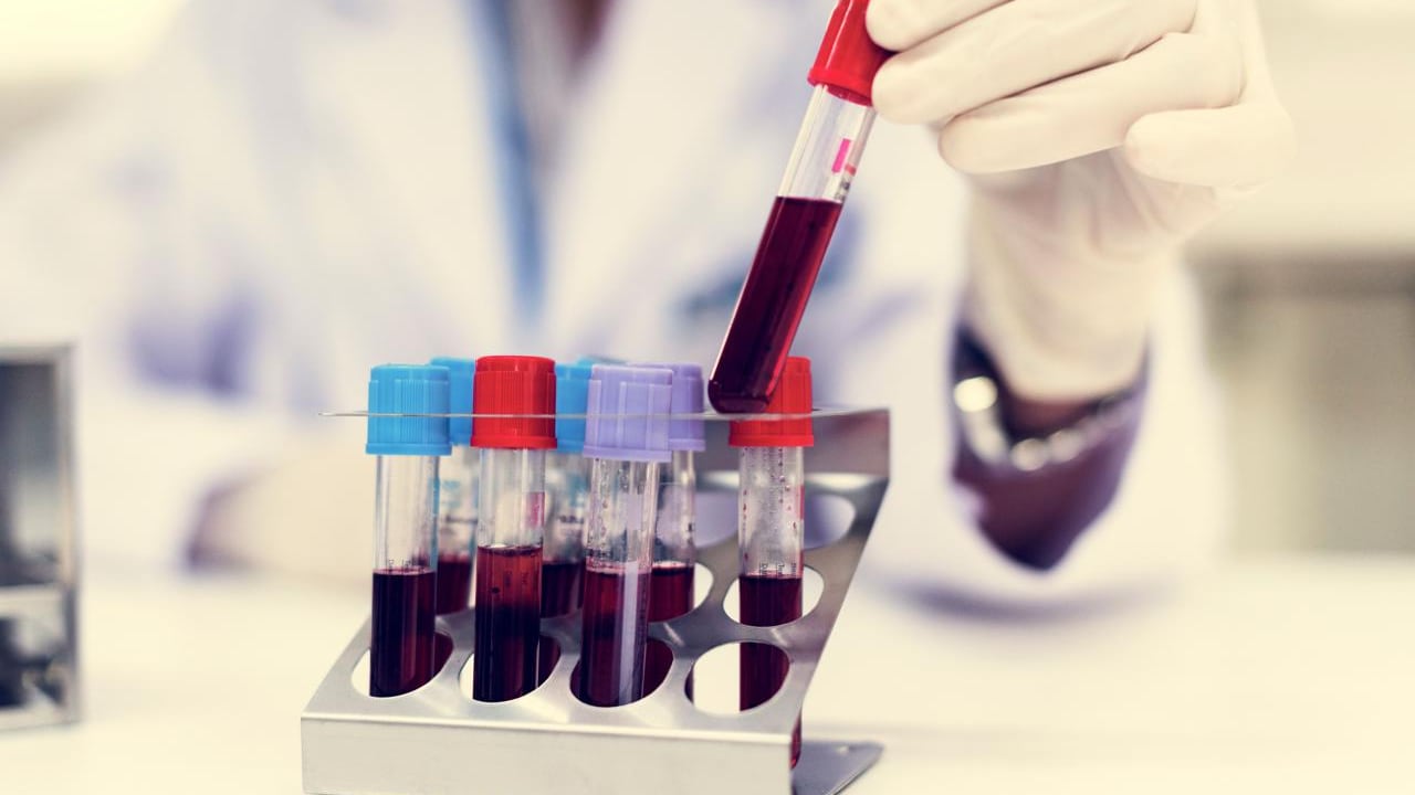 Schizofrenia, trovate nel sangue le "spie" della malattia