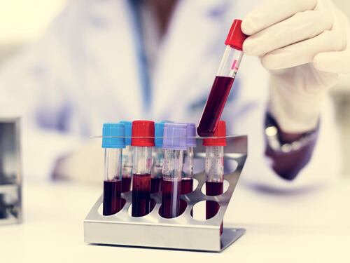 Schizofrenia, trovate nel sangue le "spie" della malattia