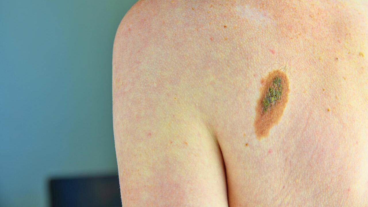 Aumentano le diagnosi dei tumori della pelle: ecco le cause