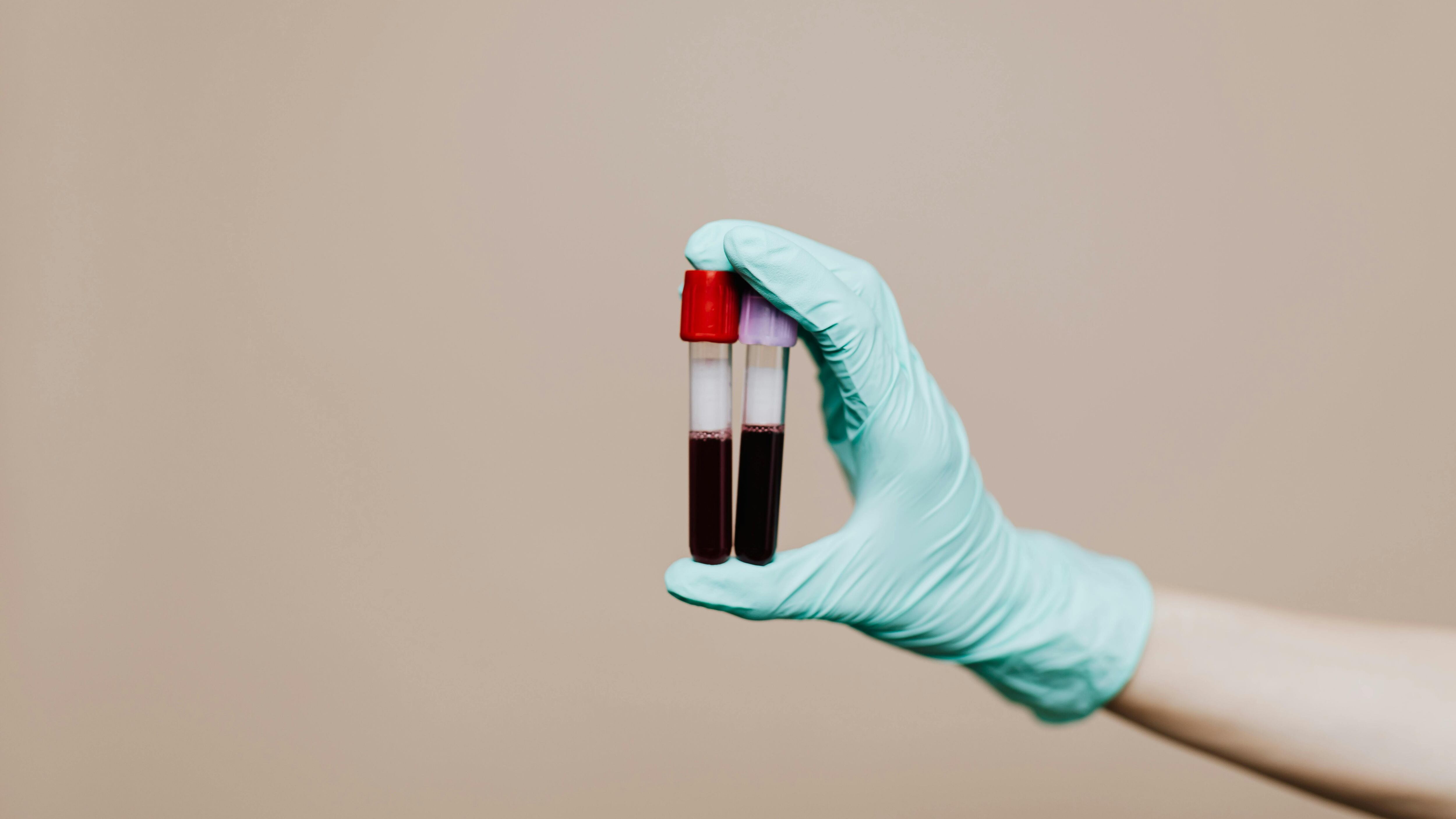 Anemia perniciosa, attenzione a questi sintomi