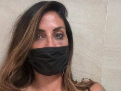 Aggressione a Guendalina Tavassi: "Frattura del naso e contusioni multiple"