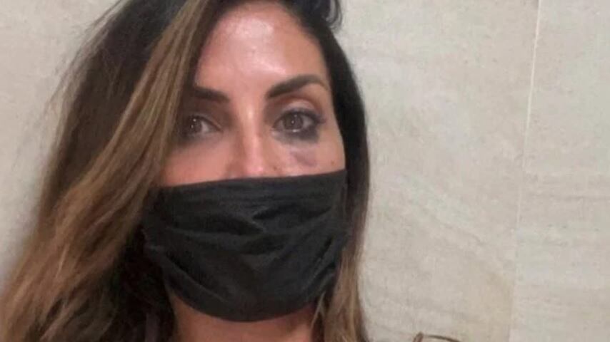 Aggressione a Guendalina Tavassi: "Frattura del naso e contusioni multiple"