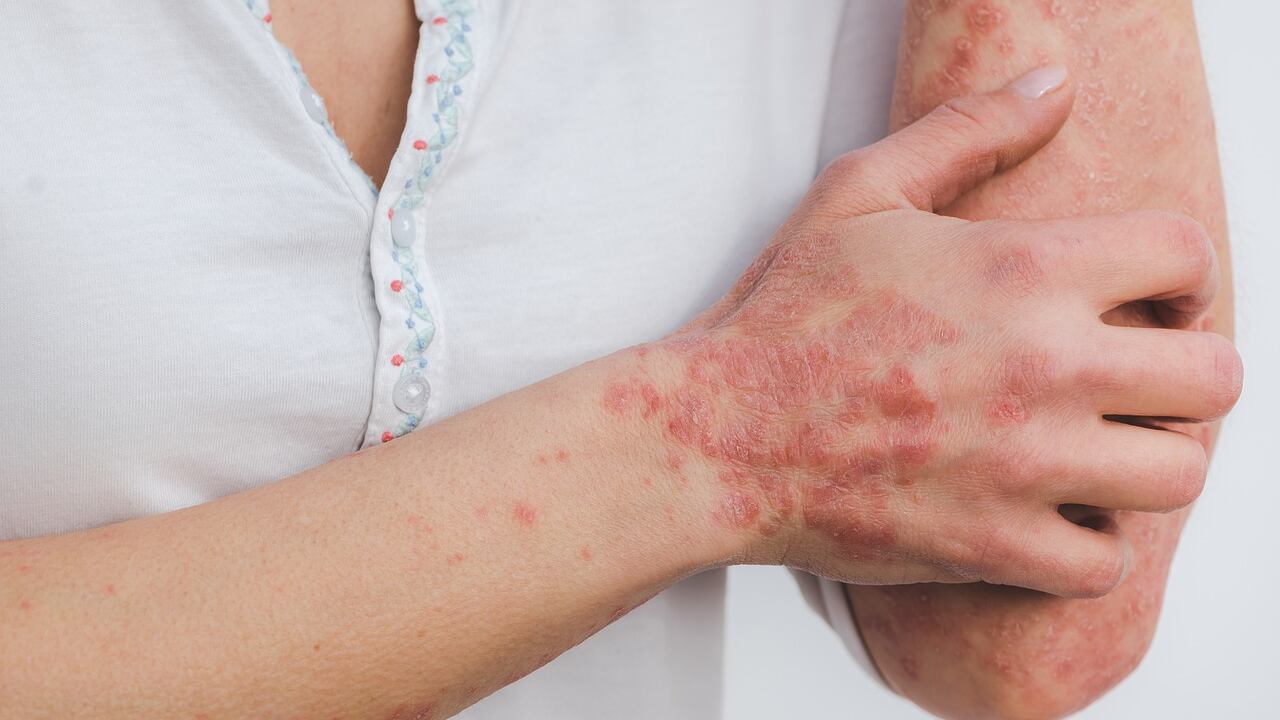 Psoriasi: tipologie, cause e sintomatologia