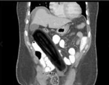 Pazze radiografie: gli oggetti che possono finire nel corpo umano 8