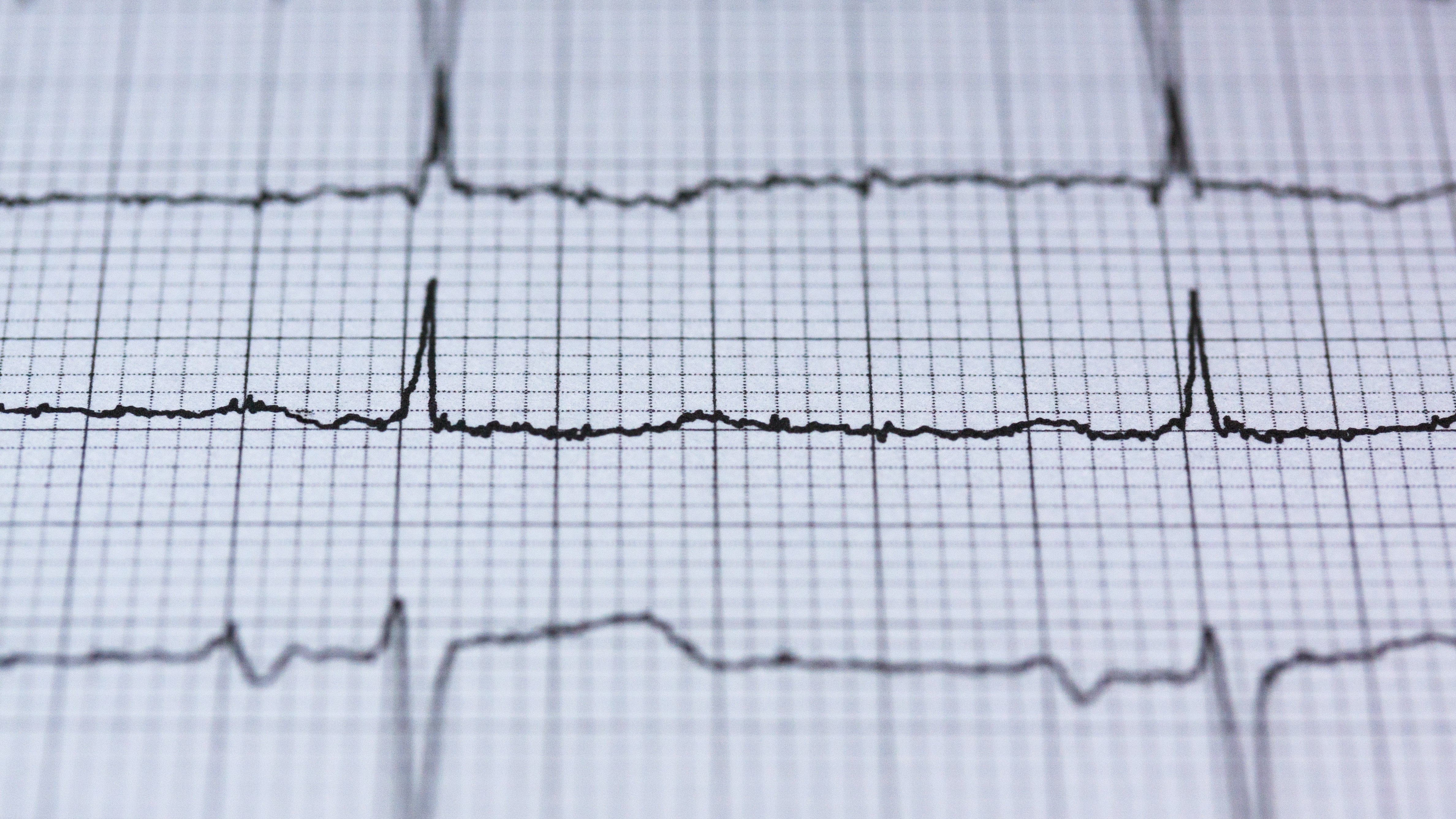 37 secondi per svelare l’infarto: la rivoluzione dell’intelligenza artificiale