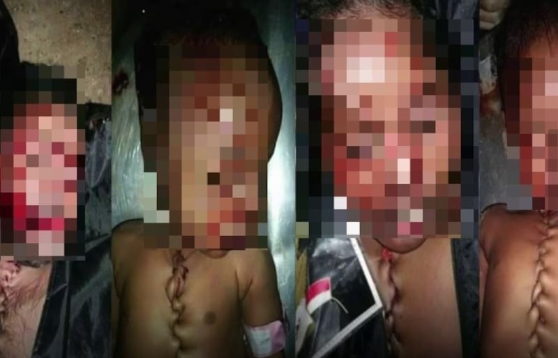Bimbi "ricuciti" per il trapianto di organi