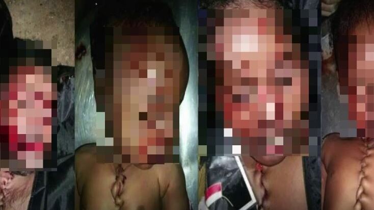 Bimbi "ricuciti" per il trapianto di organi
